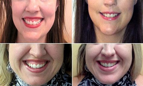 upper lip botox injections fix smiles that are too gummy daily mail