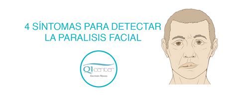 paralisis facial sintomas