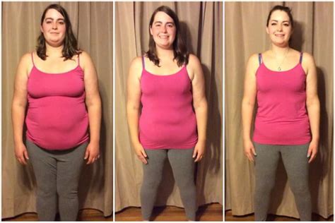 Hcg Weight Loss Program Before And After Wayzata Mn Wayzata Cosmetic