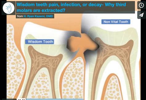 Wisdom Teeth Pain Infection Or Decay Why Third Molars