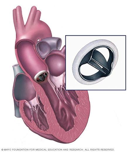 25 Beautiful Heart Valve Replacement