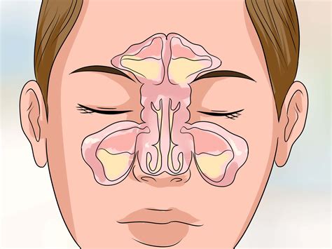 rid   stuffy nose quickly  pictures wikihow