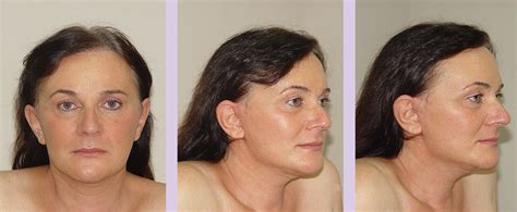 Dr Chettawut S Facial Feminization Surgery Gallery D2