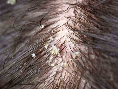 Dandruff Hair Loss Ayurgem Ayurveda Treatment Kerala