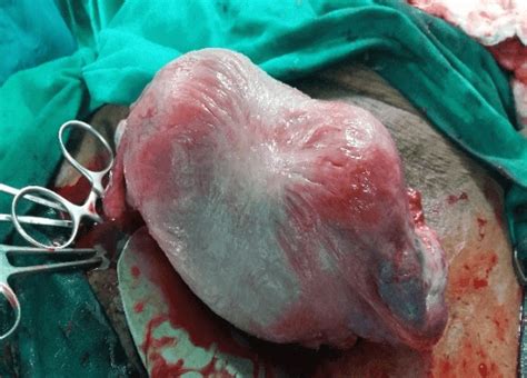 term pregnancy in a woman with incomplete transverse vaginal septum an
