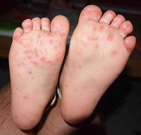 hand foot and mouth disease pediatric associates of austin