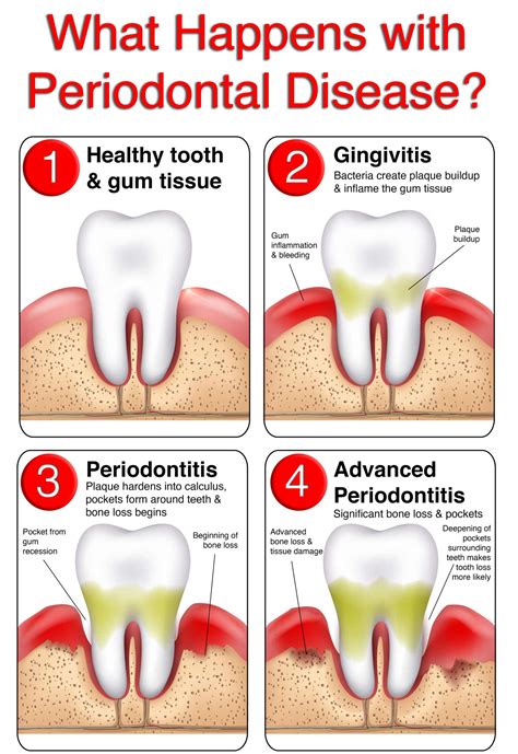 periodontal disease smiles belleville