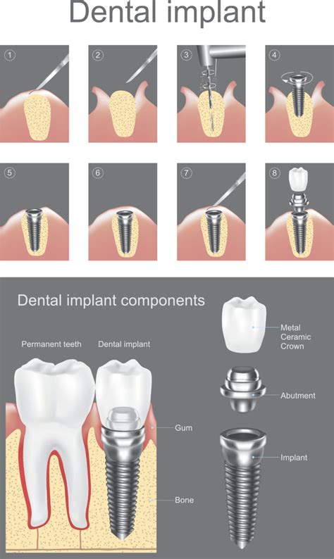 dental implants process palmdale teeth implant procedure