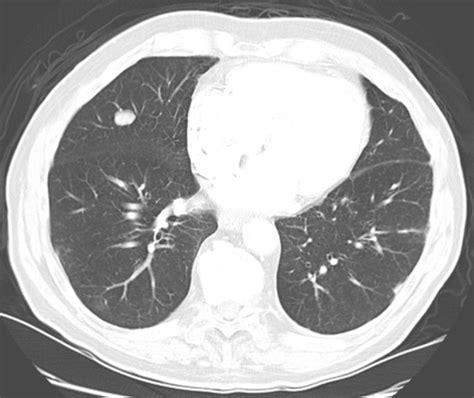 lung nodule  refused  grow psnet