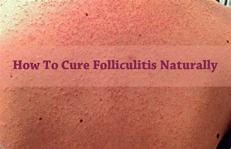 folliculitis pictures bikini porn clips