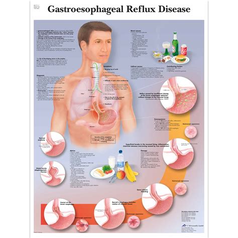 anatomical charts  posters anatomy charts digestive system charts gerd chart