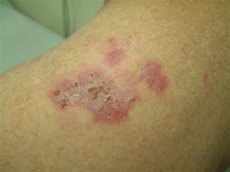 health  trusted sources basal cell carcinoma