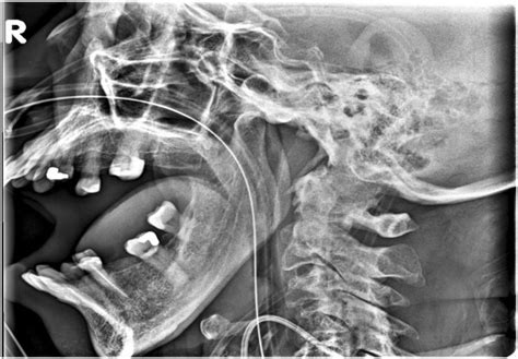 unrecognized bilateral temporomandibular joint dislocation