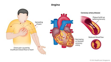 angina pectoris chest pain   symptoms parkway east hospital