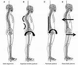 Posture Types Spine Alignment Ideal Postura Type Bad Fix Back Affect Different Espalda La Skeletal System Pilates Corporales Columna Tablero sketch template