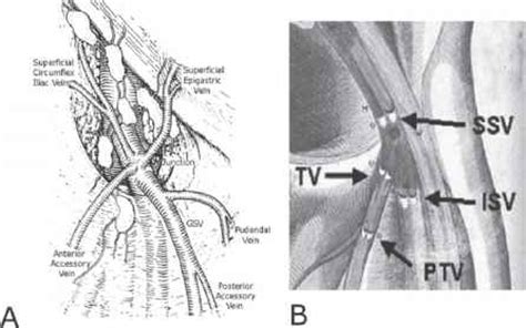 great saphenous vein varicose veins flanders health blog