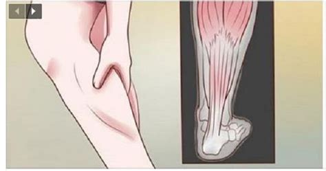 do your legs cramp at night here is how to stop it from happening ever