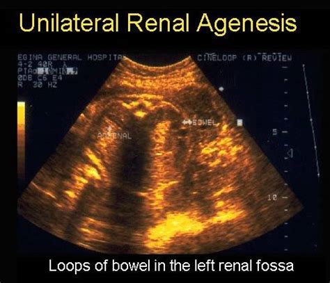 unilateral renal agenesis