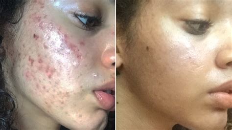 natural acne skin care routine   viral  instagram allure