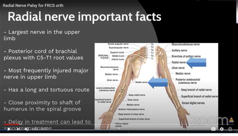 radial nerve injuries   frcsorth exam orthopaedicprinciplescom