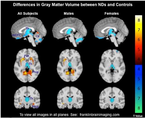 Differences In Gray Matter Volume Gmv Between Nicotine