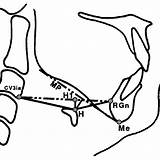 Hyoid Bone Mandibular Variables H1 Posture Morphology Airway Severity Apnoea sketch template
