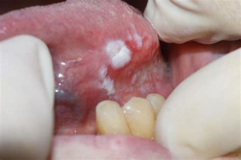 cancer oral master odontología ub master odontologia