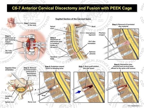 C6 7 Anterior Cervical Discectomy And Fusion With Peek Cage