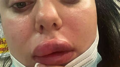 woman almost blinded after botched £70 lip filler injection goes