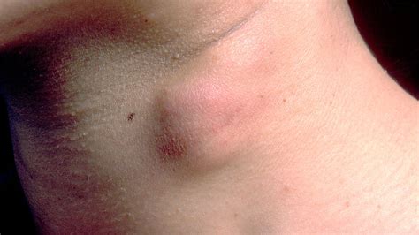skin lump symptoms  diagnosis treatment