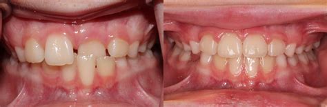 baby teeth  permanent teeth wwwsimplyxpresscom