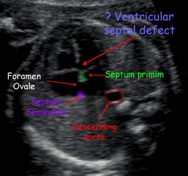 fetal heart ultrasound   obstetric ultrasound ultrasound