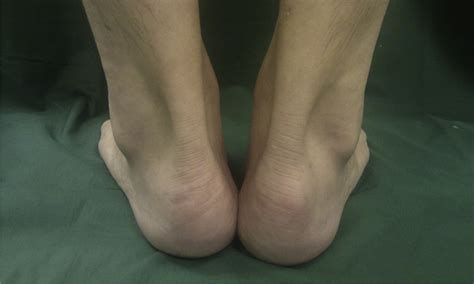 surgical correction of haglund s triad using a central tendon splitting