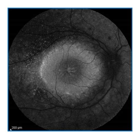 color fundus photography   patient  enhanced  cone syndrome