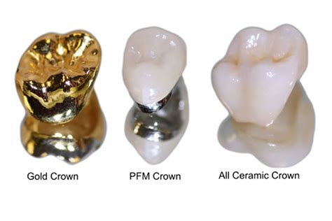 full ceramic crown types  ceramic