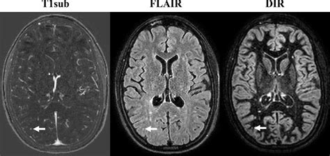 Non Contrast Mri Is Effective In Monitoring Multiple Sclerosis Patients