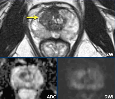 The Radiology Assistant Prostate Cancer Pi Rads V2 1