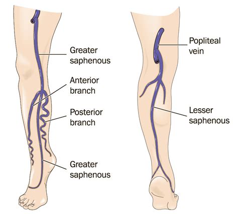 great  small saphenous veins insufficiency montreal treatment