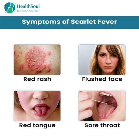 Scarlet Fever Symptoms And Treatment Infectious Disease