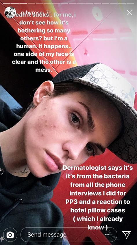 Ruby Rose Slams Reports About Her Acne And Weight This Is The Problem