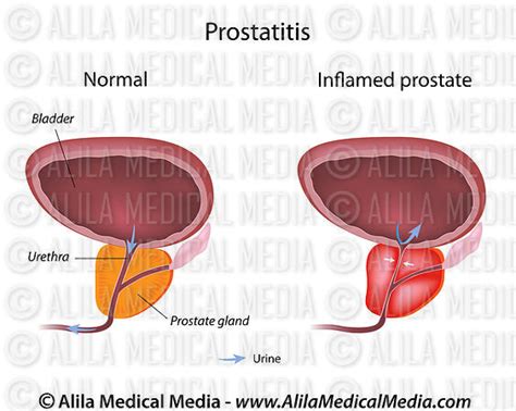 Alila Medical Media Prostatitis Medical Illustration