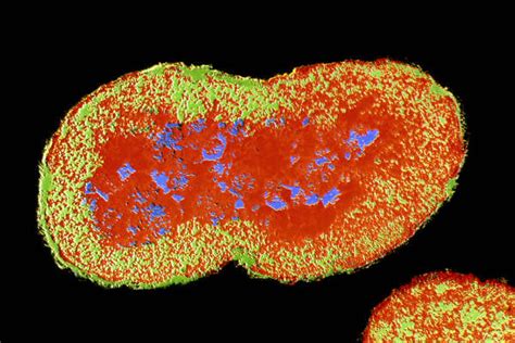 Drug Resistant Gonorrhea Spreading Worldwide Who Warns