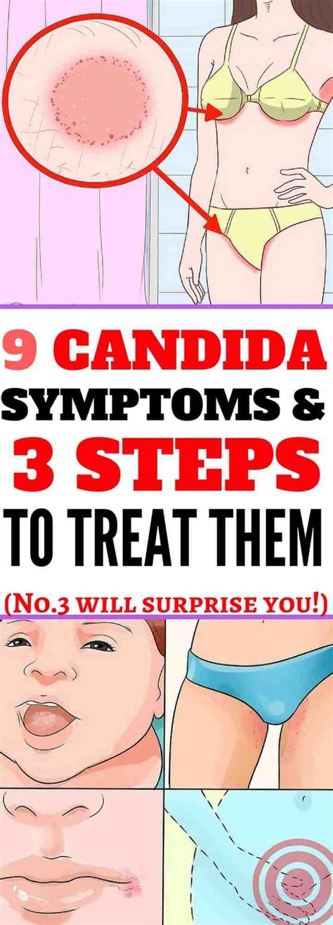 Here Are 9 Candida Symptoms And 3 Steps To Treat Them Candida