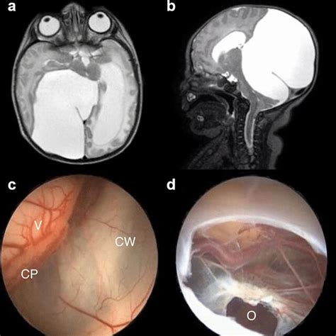 ct scan shows ventricular enlargement   proximal