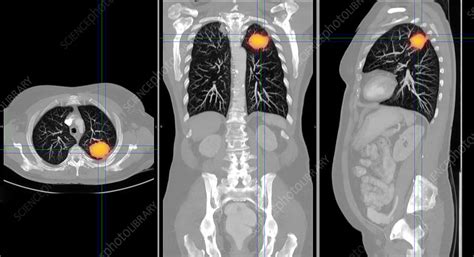 Lung Cancer Ct Scan Stock Image C012 3829 Science