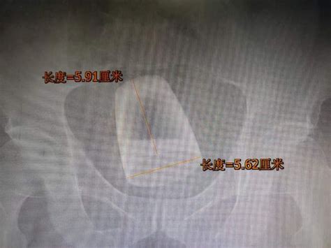 China Man Undergoes Surgery To Remove Beer Glass From Rectum World News
