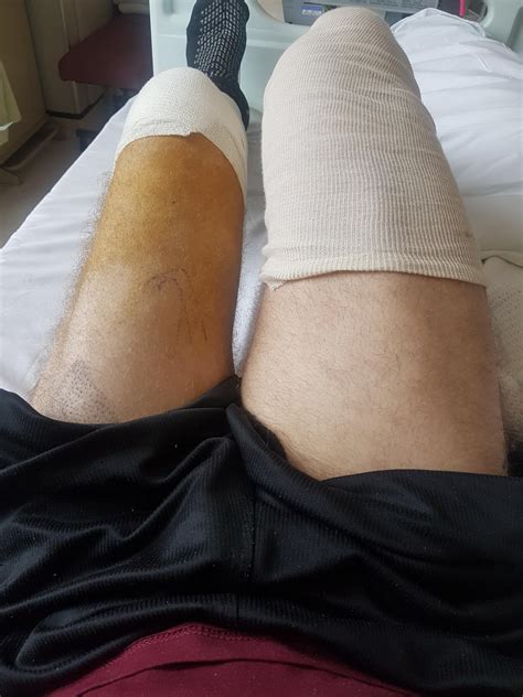 muscle atrophy   left leg    weeks   full leg cast