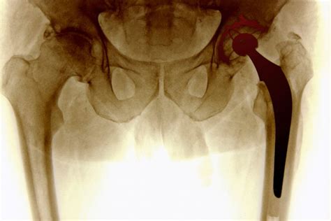 Surprise Path To Better Sex Hip Surgery Huffpost