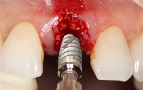surgical placement  dental implants  restorative driven approach glidewell direct