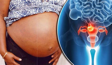 Uterine Fibroid Non Pregnant Big Tummy In A Woman Air Clinic